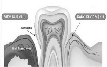 Viêm nha chu - một nguyên ngân gây chảy máu chân răng.