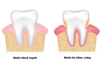Các bệnh như viêm quanh răng, túi bệnh lý sâu là nguyên nhân thường gặp của tụt lợi.