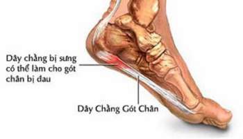 Đau nhức gót chân là triệu chứng lâm sàng của nhiều bệnh.