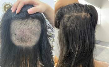 Chi 90 triệu để cấy 2cm tóc trị trán dô: Từng bất an cực độ vì tóc rụng lả tả, nhưng vài tháng sau lại cho kết quả mê ly không ngờ - Ảnh 8.