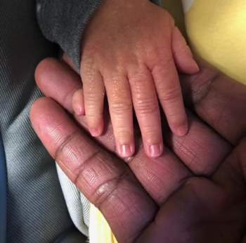 Bé gái sinh ra với 12 ngón tay do mắc phải căn bệnh này - Ảnh 1.