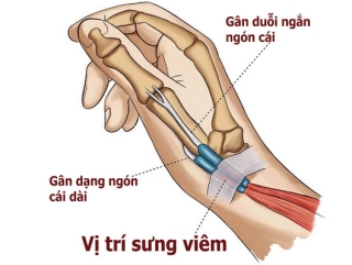 Cần tập các bài tập cho gân khớp vùng cổ tay.