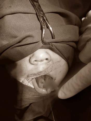 Bé 10 tháng tuổi bị đứt lưỡi vì lật ngã khi đang đi xe tròn tập đi - Ảnh 1.