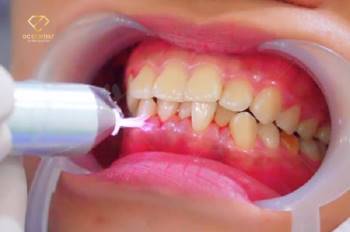 Plasma 6D – Đột phá mới trong phục hình răng sứ siêu tương thích - 2
