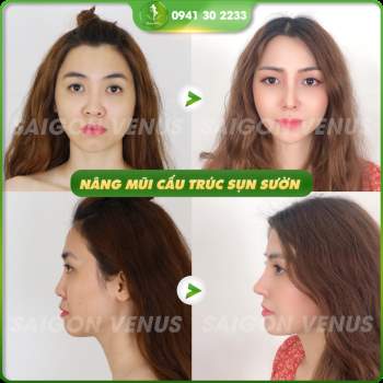 Nâng mũi hay tiêm filler, lựa chọn thế nào cho phù hợp? - ảnh 11