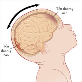 Bé gái 8 tháng tuổi bị bại não vì ông bà nội bế trên tay và rung lắc cho cháu ngủ trong một thời gian dài - Ảnh 2.