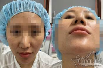 Bác sĩ cắt sụn sườn nâng mũi cho cô gái Hà Nội