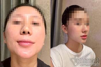 Bác sĩ cắt sụn sườn nâng mũi cho cô gái Hà Nội