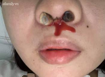 Thêm nhiều nạn nhân tố cáo bác sĩ Hồ Phi Nhạn, thẩm mỹ viện Natural sửa mũi gây biến chứng - Ảnh 6.