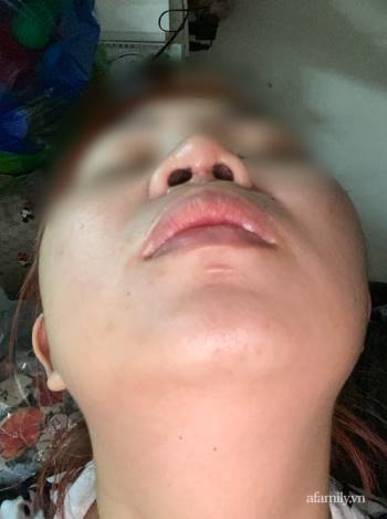 Thêm nhiều nạn nhân tố cáo bác sĩ Hồ Phi Nhạn, thẩm mỹ viện Natural sửa mũi gây biến chứng - Ảnh 3.