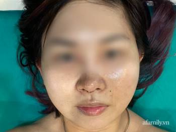 Thêm nhiều nạn nhân tố cáo bác sĩ Hồ Phi Nhạn, thẩm mỹ viện Natural sửa mũi gây biến chứng - Ảnh 4.