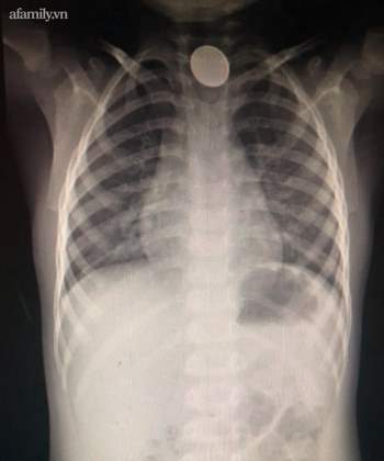 Bé trai 4 tuổi nuốt cục pin gỉ sét bị bỏng thực quản nguy hiểm: Bác sĩ cảnh báo nguy cơ ngộ độc cấp tính - Ảnh 2.