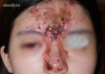 Nâng mũi bằng filler tại một spa ở TP.HCM, cô gái 24 tuổi giảm thị lực, mặt sưng tấy chảy dịch khủng khiếp - Ảnh 2.