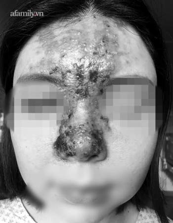 Nâng mũi bằng filler tại một spa ở TP.HCM, cô gái 24 tuổi giảm thị lực, mặt sưng tấy chảy dịch khủng khiếp - Ảnh 1.
