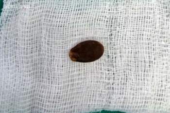 Hàng loạt trẻ dưới 3 tuổi bị hóc hạt dưa, hạt đậu phộng dịp Tết Nguyên đán phải nhập bệnh viện ở TP.HCM cấp cứu - Ảnh 1.