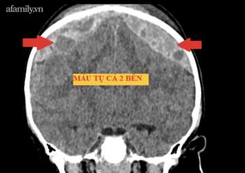 Cưa hộp sọ cứu bé trai ở Đồng Nai té giường tầng xuất huyết não - Ảnh 1.