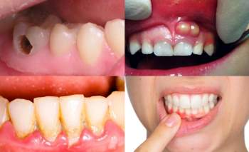 Trẻ có những dấu hiệu nào khiến bố mẹ phải để ý về thẩm mỹ hàm răng ngay từ khi còn bé? - Ảnh 2.