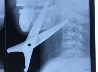 Bé trai 7 tuổi nhập viện với chiếc kéo đâm xuyên vào cổ
