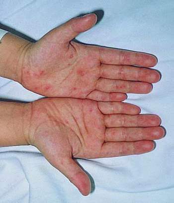 Bệnh tay chân miệng ở trẻ: Những biến chứng nghiêm trọng, cách nhận biết, điều trị bệnh cha mẹ cần nắm được để phòng bệnh cho con - Ảnh 2.