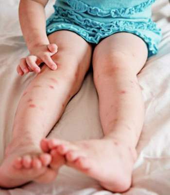 Bệnh tay chân miệng ở trẻ: Những biến chứng nghiêm trọng, cách nhận biết, điều trị bệnh cha mẹ cần nắm được để phòng bệnh cho con - Ảnh 6.