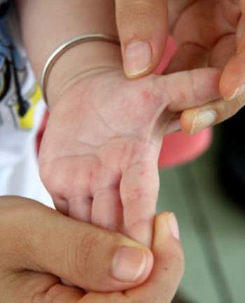Bệnh tay chân miệng ở trẻ: Những biến chứng nghiêm trọng, cách nhận biết, điều trị bệnh cha mẹ cần nắm được để phòng bệnh cho con - Ảnh 10.