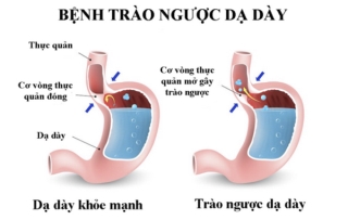 Quất hồng bì trị trào ngược dạ dày.