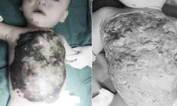 Đắp Thuốc chữa bỏng của thầy lang, bé trai 13 tháng tuổi bị hoại tử da