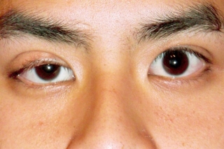 Các căn bệnh ẩn sau những dấu hiệu bất thường của mắt