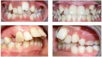 Trẻ có những dấu hiệu nào khiến bố mẹ phải để ý về thẩm mỹ hàm răng ngay từ khi còn bé? - Ảnh 1.