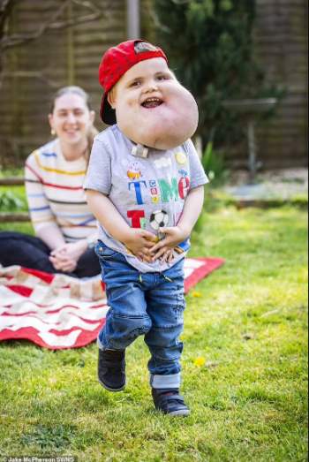 Cậu bé 4 tuổi với gương mặt to như quả bưởi khổng lồ vì khối u, cùng nghị lực phi thường đằng sau gây xúc động - Ảnh 1.