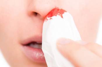 Căn bệnh ung thu vòm họng: Chảy máu cam và những dấu hiệu đặc biệt bị nhiều người xem thường - Ảnh 3