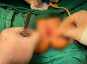 Bé gái 8 tuổi ở Đà Lạt bất ngờ chảy máu V*ng k*n, phải xuống TP.HCM phẫu thuật vì căn bệnh hiếm gặp - Ảnh 1.