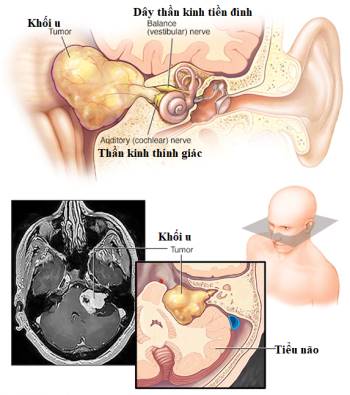 Chóng mặt, nghe kém, phát hiện u trong não - Ảnh 1.