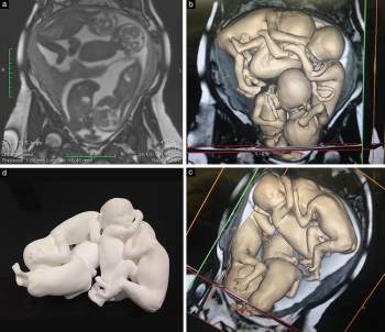 Hình ảnh mô hình vật lý 3D của thai nhi được dựng lại dựa trên kết quả siêu âm khiến nhiều người phải kinh ngạc - Ảnh 2.