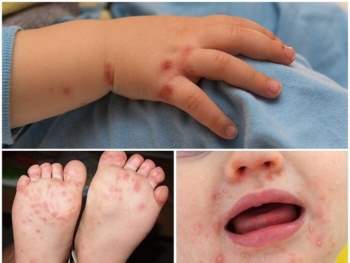 Hà Nội: Dịch chân tay miệng đang gia tăng, chủ yếu ở trẻ dưới 5 tuổi - Ảnh 2.