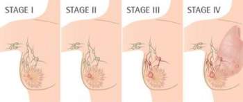 Các giai đoạn ung thư vú