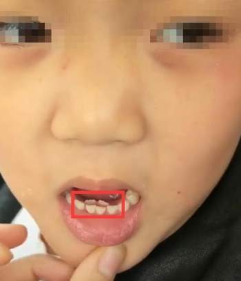 Bé gái 8 tuổi tự nhiên kêu đau răng, bà đưa đi khám thì đã thấy răng mọc thành hai hàng - Ảnh 1.
