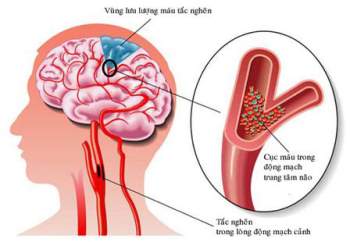 Những người bệnh đã phát hiện rung nhĩ, nguy cơ đột quỵ rất cao - Ảnh 2.