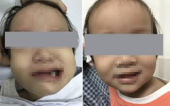 Bé gái 17 tháng tuổi bị viêm xương chũm cấp, biến chứng méo miệng - Ảnh 1.