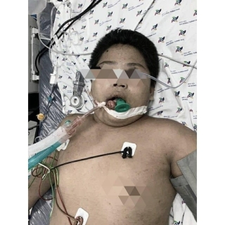 Nam sinh 14 tuổi phù phổi, hôn mê do bị bạn nhấn nước khi đi bơi - ảnh 2