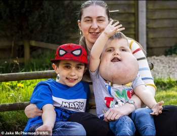 Cậu bé 4 tuổi với gương mặt to như quả bưởi khổng lồ vì khối u, cùng nghị lực phi thường đằng sau gây xúc động - Ảnh 3.