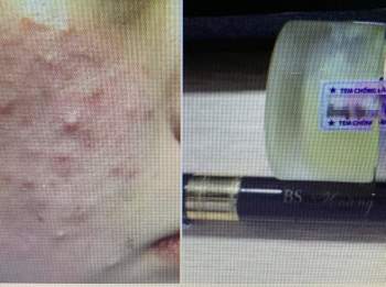 Bệnh nhân nữ bị tổn thương giống bạch biến sau khi đắp kem trộn để làm đẹp da sau một tuần - Ảnh 2.