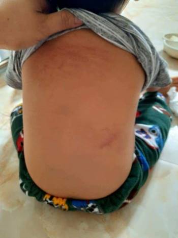 Hình ảnh cháu H. với những vết đỏ trên người nghi bị bạo hành. Ảnh: baogiaothong.vn