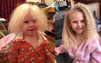 Mắc hội chứng hiếm gặp, bé gái người Anh sở hữu mái tóc y hệt thiên tài Vật lý Einstein - Ảnh 1