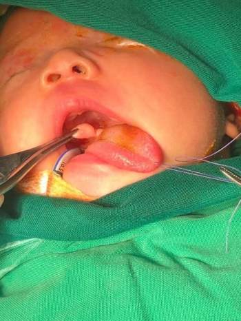 Bệnh nhân nhi 21 ngày tuổi bị u gốc lưỡi hiếm được phẫu thuật thành công kịp thời - Ảnh 1.