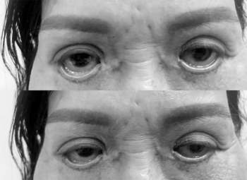 Thẩm mỹ ‘chui’ hoành hành: Một phụ nữ bị trợn ngược mắt sau cắt mí tại spa - ảnh 1