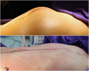 Phẫu thuật khối u di căn ổ bụng cho bệnh nhân ung thư tinh hoàn - Ảnh 2.