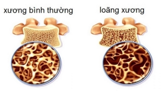 Bệnh loãng xương tiến triển thầm lặng.