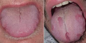 'Covid lưỡi', triệu chứng mới của đại dịch - Ảnh 1.