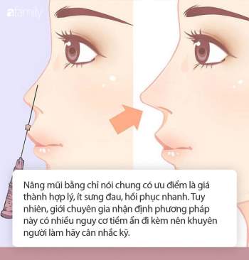 Nâng mũi bằng chỉ có gì hay mà chị em đang nô nức rủ nhau đi làm trước khi năm mới sang? - Ảnh 3.